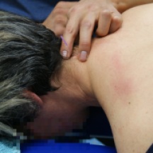 Figure 5.2.1a Needling of a trigger point in the rectus capitus