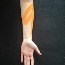 Taping of the forearm