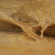 Saphenous vein coming fromdeep to superficail layers through the fascia